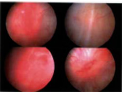 Figura 1. Demostración de las úlceras de Hunner en la paciente durante la cistoscopia.