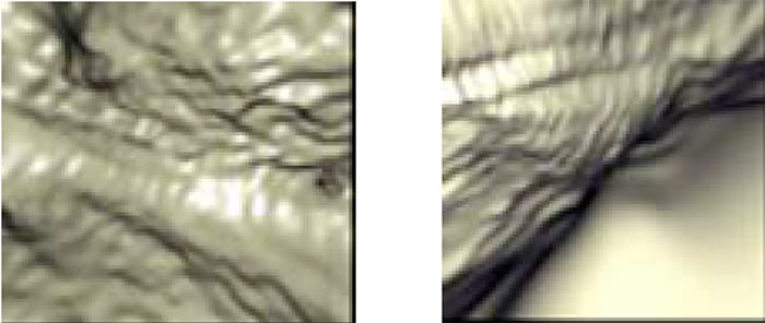 Figura 6. Imágenes de cistoscopia virtual muestran áreas de engrosamiento difuso de la pared vesical.