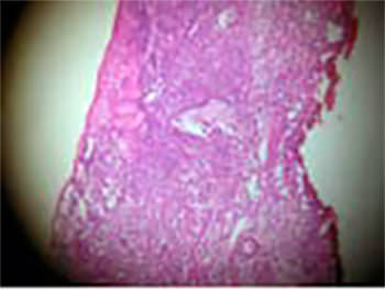 Figura 7. Los hallazgos histopatológicos muestran una mucosa vesical con un infiltrado inflamatorio de linfocitos, células plasmáticas y ocasionales neutrófilos, los cuales se insinúan hasta la muscularis de la vejiga. Se observa además edema, congestión vascular y focos de hemorragia reciente. Algunos de los fragmentos se observan ulcerados. El epitelio de revestimiento presenta cambios reactivos los cuales confirman el diagnóstico de cistitis crónica intersticial (úlcera de Hunner).