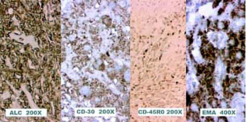 Figura 2. Estudio inmunohistoquímico mediante técnica de Avidina-Estreptavidina y utilizando métodos de recuperación de antígeno que concluyó linfoma anaplásico de células grandes con inmunofenotipo T.