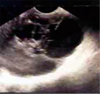 Figura 1. Imagen multiloculada de 100 x 66 mm con ecos comienzo de actividad sexual a edades tempranas, finos en su interior que deja reforzamiento posterior.