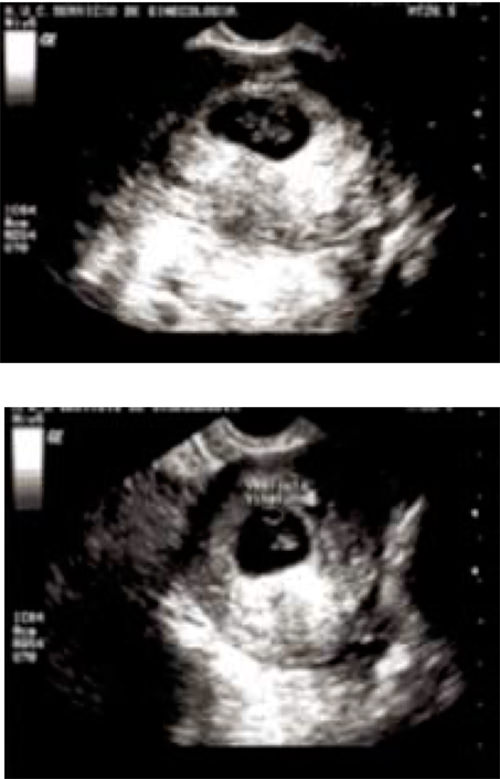 Figura 1. El ecosonograma transvaginal reporta: útero en AVF, con embrión correspondiente según LCR a 6 semanas con actividad cardíaca presente, con imagen anecoica en ovario derecho de 58 x 40 x 36 mm, con imagen hiperecoica en su interior que pudiera corresponder a embarazo ectópico derecho y moderado líquido libre en cavidad.