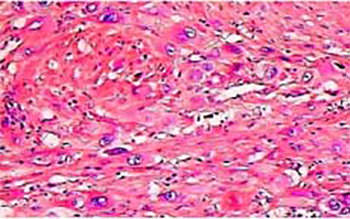 Figura 2. La biopsia reporta: trompa izquierda de 6,5 x 2,5 cm, de longitud, dilatada. Serosa hemorrágica, pared rota, concluyendo como embarazo ectópico izquierdo roto y fragmento de trompa derecha sin alteraciones (hematoxilinaeosina).