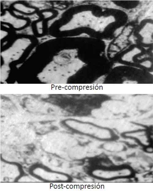 Fig 1. Imagen microscópica de las fibras neurológicas en el ganglio de Gasser antes y después de la compresión.