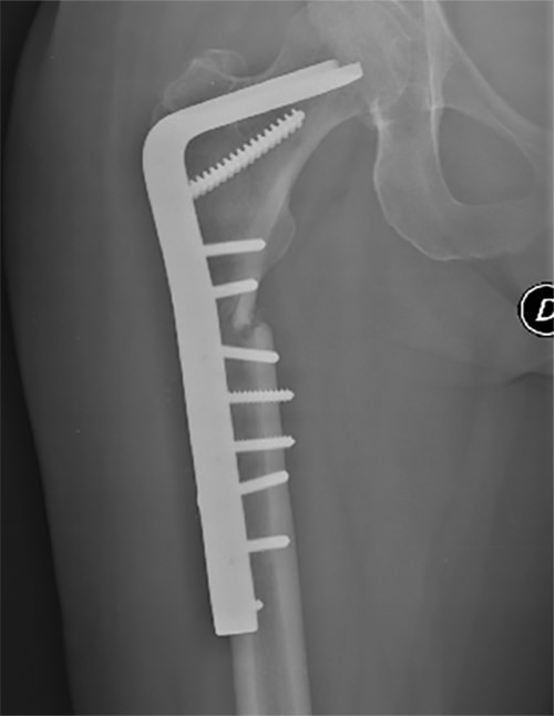 Fig 8. Radiografía simple postoperatoria del caso presentado. Osteosíntesis con placa condílea de 95° y colocación de injerto óseo.