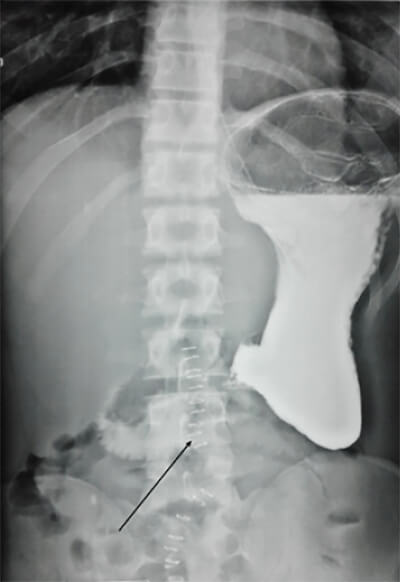 Figure 2. a: shows cutoff of barium over spine, what indicates the narrowing of the horizontal part of the duodenum and few contrast and gas in the intestine distal to the point of obstruction.