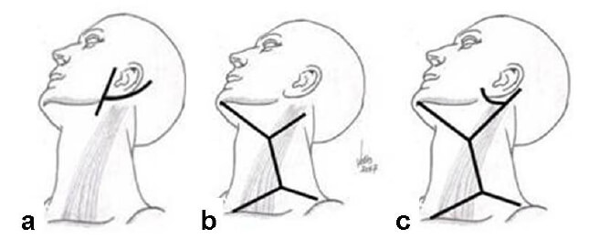 Figura 1. Incisiones diseñadas por Hayes Martin para el abordaje quirúrgico de neoplasias de cabeza y cuello. a) Parotidectomía. b) Disección cervical radical. c) Disección cervical radical con extensión a parótida.