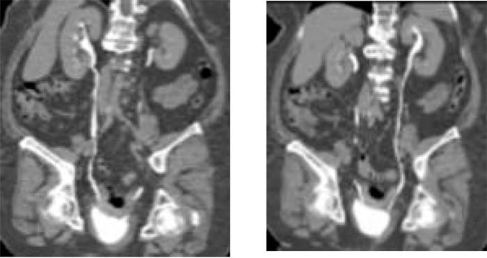 Figura 3. Imágenes en plano curvo coronal siguiendo trayectos ureterales donde no evidencian alteraciones a este nivel.