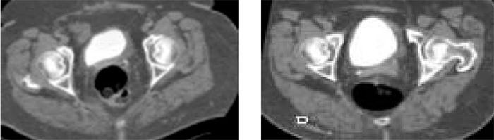 Figura 4. Imágenes en plano axial en posición supino (A) y prono con máxima repleción vesical (B), en las cuales se observa engrosamiento difuso de la pared vesical a predominio del contorno lateral izquierdo con limitación en su distensibilidad.