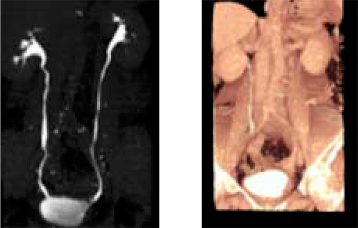 Figura 5. Imágenes tridimensionales en máxima intensidad de proyección (MIP) y volumen rendering (VR), en las cuales se evidencia adecuada fase de eliminación con disminución de la distensión vesical y defecto de repleción en contorno vesical izquierdo.