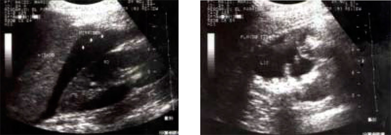 Figura 1. El ecosonograma abdominopélvico demuestra líquido libre en cavidad.