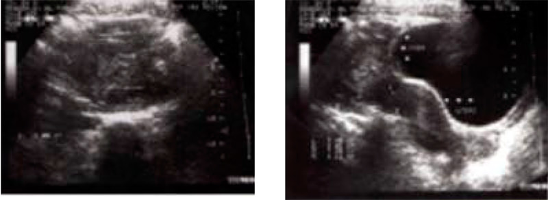 Figura 2. Imagen parauterina izquierda de 8 cm de diámetro.