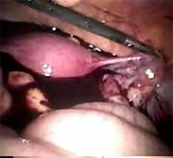 Figura 3. Hallazgo de 1 000 cm3 de hemoperitoneo durante la laparoscopia.