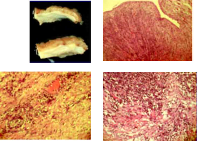 Figura 3. Al examen histológico se aprecian folículos primarios e infiltrado linfo-plasmocitario, concluyendo como absceso tubo-ovárico, inflamación crónica reagudizada severa y presencia de tejido de granulación.