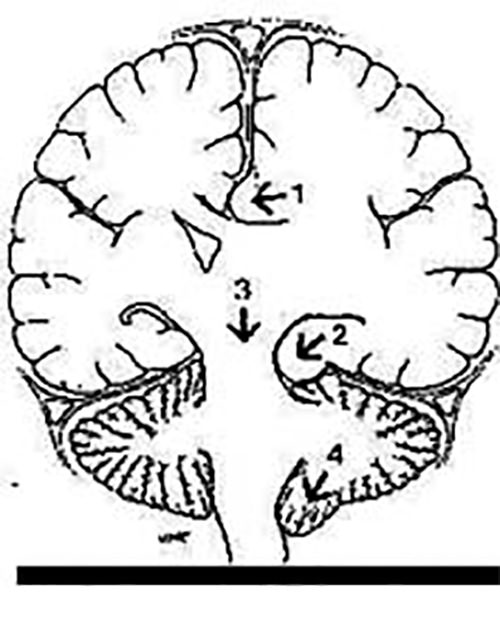 Figura 2. Las hernias cisternales más frecuentes son la 1: subfalciforme; 2 uncal; 3 central transtentorial; 4 tonsilar.