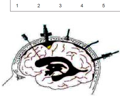 Figura 4. Se observa las diferentes localizaciones de los monitores: 1 intraventricular, no costoso y con ventaja de drenaje de LCR. 2-4-5- localizaciones aracnoideas y 3 epidural. El camino puede ubicarse en diferentes localizaciones y a la derecha el sensor Ladd en fontanelas permeables.