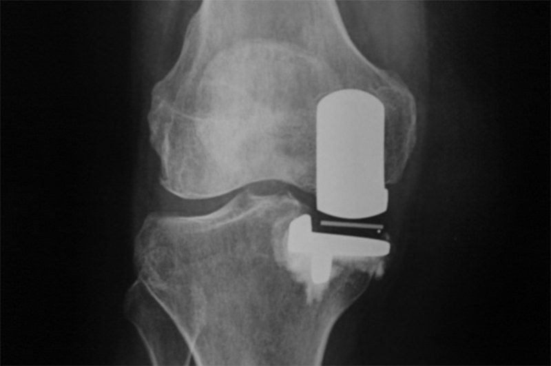 Figura 4. Vista anteroposterior, 3 años de seguimiento.