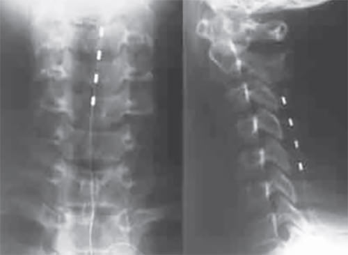 Figura 2. Rayos X que muestra electrodo percutáneo en región cervical.