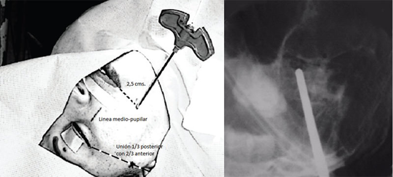 Fig. 4. Referencias externas para la localización del agujero oval. Visualización del agujero oval en la proyección antero-posterior.