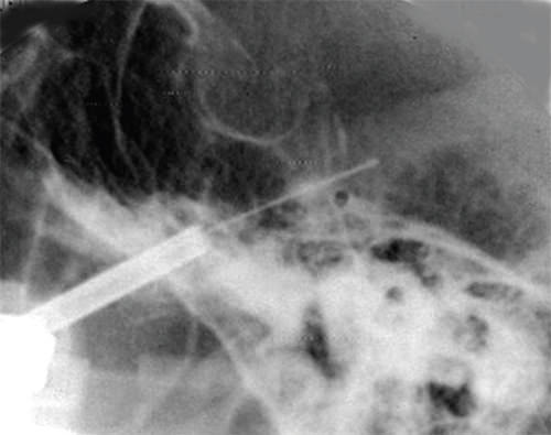 Fig. 5. Proyección lateral. Paso del Seldinger. Dirección al ángulo formado entre el clivus y la cara anterior del peñasco.