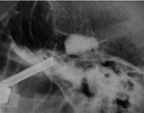 Fig. 6. Balón de Fogarty inflado en la fosa de Gasser y cavum de Meckel adquiriendo la adecuada forma “en pera”, que ratifica su adecuado posicionamiento.