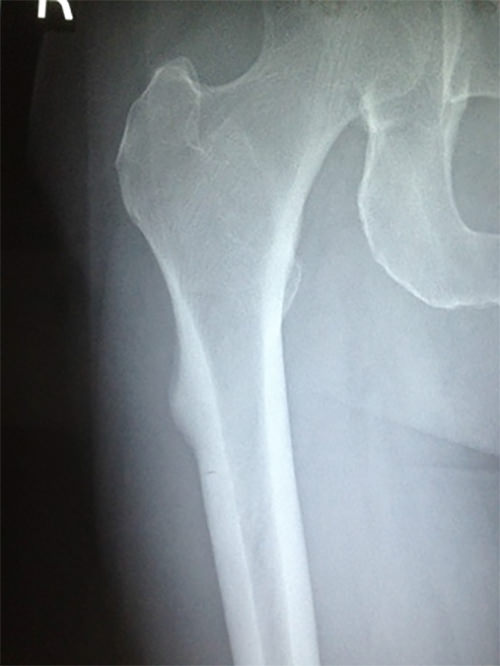 Fig 2. Radiografía simple en proyección AP mostrando imagen de reacción exofílica (espícula) a nivel de la cortical externa de la región subtrocantérica del fémur (imagen correspondiente al caso presentado).