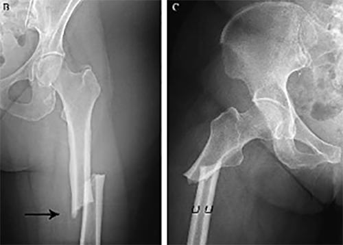 Fig 4. Radiografías en proyección AP de fémur mostrando la ubicación característica de las fracturas por BF, a nivel diafisario y subtrocantérico.