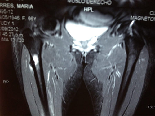 Fig 6. Resonancia magnética del caso presentado donde se evidencia, además de los hallazgos descritos anteriormente por la radiografía simple de engrosamiento cortical y espícula a nivel de la cortical externa del femur derecho, presencia de edema localizado (característico de la fracturas por estrés), sin compromiso de los tejidos circundantes.