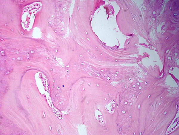 Figura 9. Trabéculas óseas aumentadas de espesor con líneas de cemento prominentes. Los canales de Havers libres de infiltración por neoplasia.