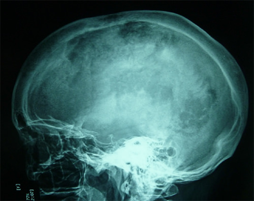 Figura 1. Imágenes osteológicas con áreas de mayor densidad que no respeta la sutura coronal, se aprecia espesor aumentado del grosor del hueso parietal con radiopacidad de la cortical interna y radiolucidez de la cortical externa.
