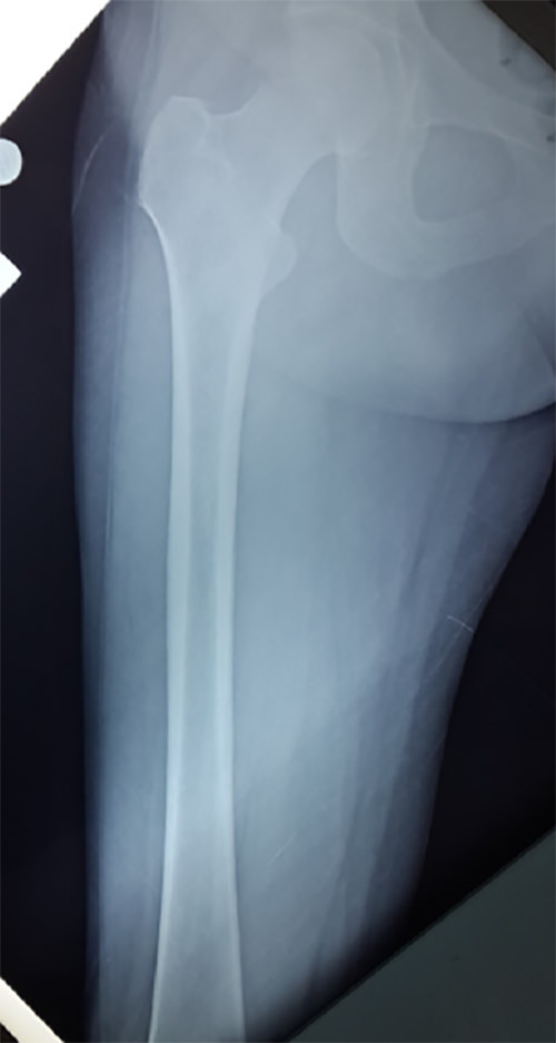 Figura 4. Rayos X de femur sin alteraciones.