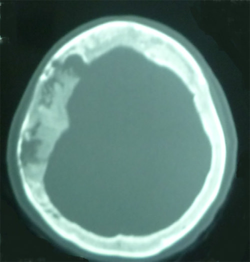 Figura 5. Tomografía axial computarizada en ventanea ósea que muestra engrosamiento diploico en huesos frontales y parietales a predominio derecho, imágenes hipodensa, irregulares en huesos frontales y parietales a predominio parietal derecho.