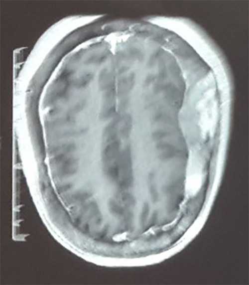 Figura 6. RMN cerebral con contraste donde se evidencia imagen heterogénea que capta contraste en región ósea fronto-parieto-occipital bilateral a predominio derecho.