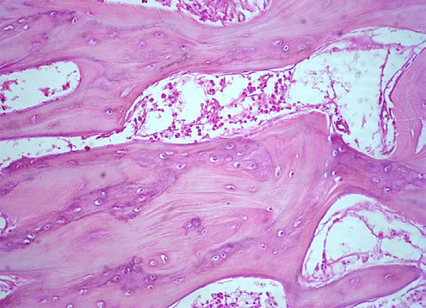 Figura 7. Hiperostosis, trabéculas óseas aumentadas de espesor, presencia de líneas de cemento prominentes.