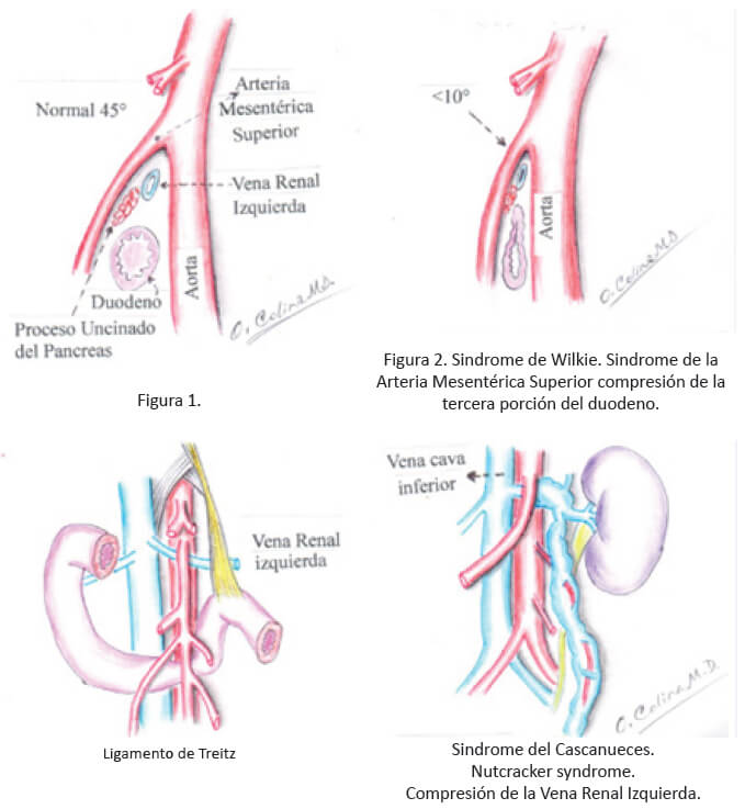 Síndrome de la arteria mesentérica superior: consideraciones diagnósticas y  terapéuticas