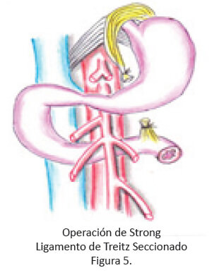 Operación de Strong Ligamento de Treitz Seccionado Figura 5.