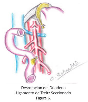 Desrotación del Duodeno Ligamento de Treitz Seccionado Figura 6.