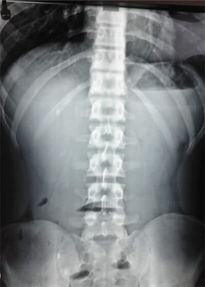 Figure 1. The X-ray of the standing abdomen shows dilatation of the stomach and few gas in the intestine distal to the point of obstruction, a characteristic image of a high partial intestinal obstruction.