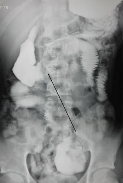 Figure 2. b: shows gastroduodenal distension with the descending portion of the duodenum well distended and cutoff of barium to right of spine with delay in the emptying of the contrast and fight sign of the stomach.