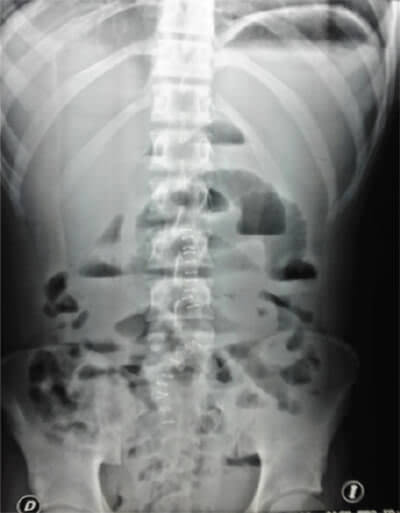 Figure 3. The radiography of the abdomen shows dilatation of small bowel loops with air-fluid levels in the epigastrium and mesogastrium.