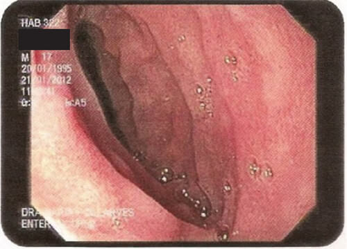 Figure 4. Enteroscopy shows the narrowing of the horizontal part of the duodenum that did not allow the endoscope to pass through.