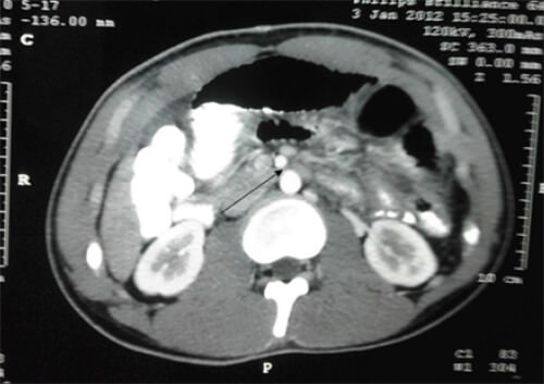 Figure 5. An axial cut of computerized tomography (TAC) shows a decrease in aortic mesenteric distance, with compression of the horizontal portion of the duodenum.