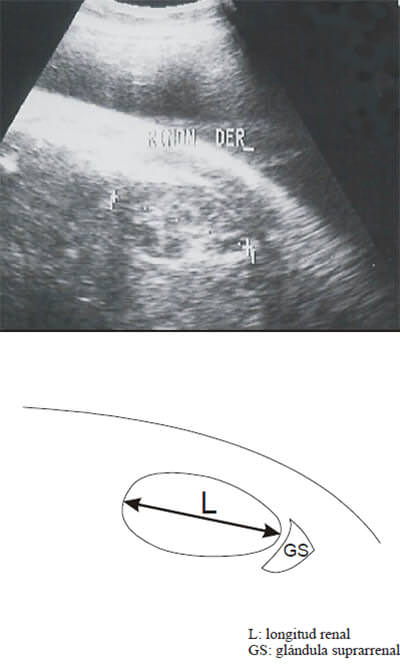 Figura 1. Diagrama representativo de la medición de la longitud renal fetal por ecografía.