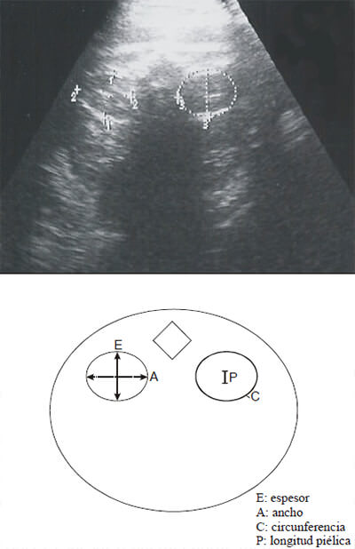 Figura 2. Diagrama representativo de la medición del espesor, ancho, circunferencia renal y longitud piélica por ecografía