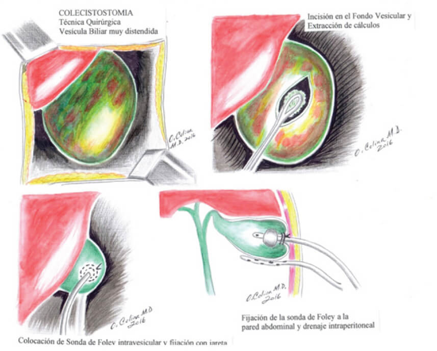 LA COLECISTOSTOMIA
