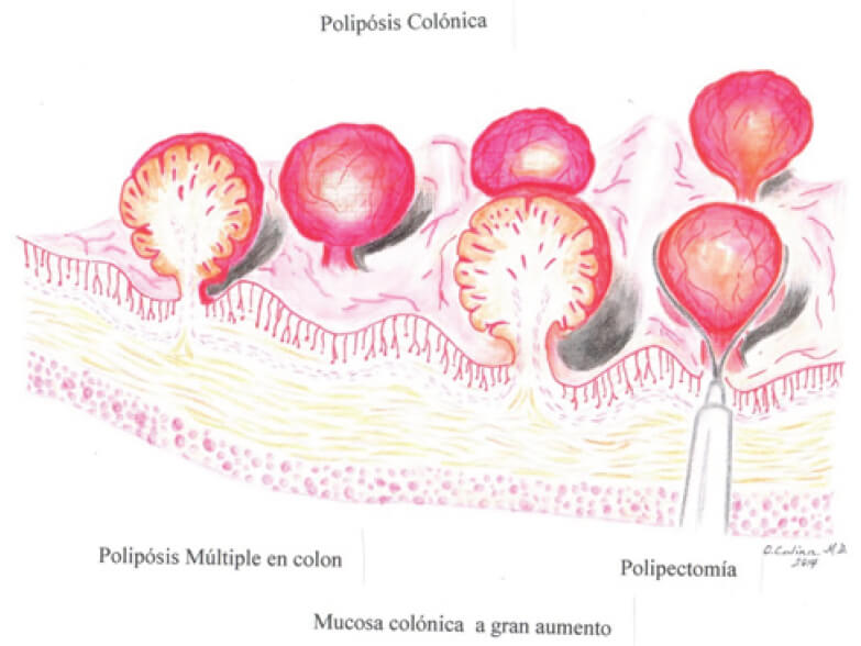 ILUSTRACION MÉDICA: POLIPOSIS ADENOMATOSA FAMILIAR