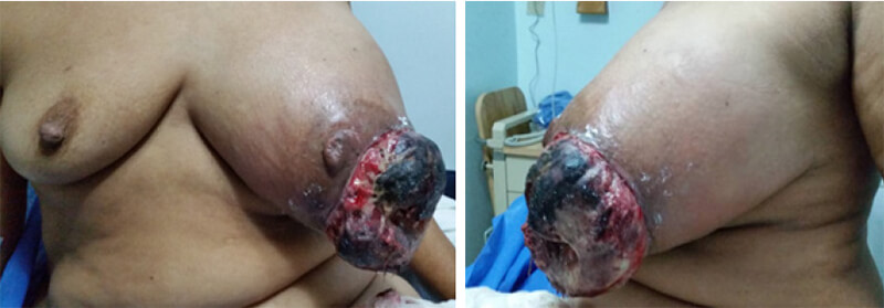 Figura 1. Paciente de 61 años con tumor de mama izquierda ulcerado.