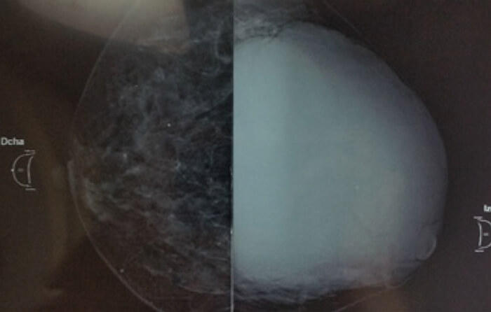Figura 2. Mamografía de paciente en su proyección craneocaudal