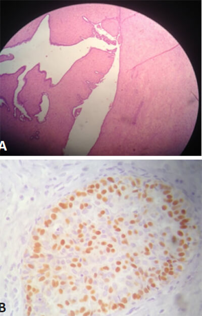 Figura 4. A.-Preparación histológica teñida con hematoxilina y eosina 20X, se observa estroma moderadamente celular con elementos epiteliales tubulares. B.- Inmunohistoquímica de ducto repleto por células neoplásicas que no infiltran la membrana basal, con reacción positiva nuclear para receptores de estrógeno.