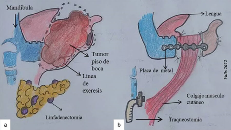 Figura 2. Esquema de la Operación Comando. a) Resección segmentaria del cuerpo lateral de la mandíbula combinada con linfadenectomía cervical por un tumor del piso de la boca. b) Reconstrucción del área de defecto con colgajo musculocutáneo, colocación de placa de metal para restablecer la continuidad de la mandíbula y traqueostomía.
Fuente: Esquema propio elaborado por el autor.